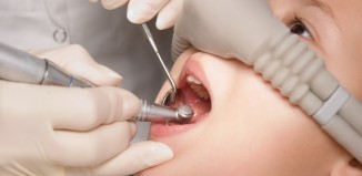Nitrous Oxide Laughing Gas for Dental Visits