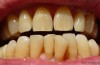 Dental Craze Lines - Hairline Cracks in Your Teeth
