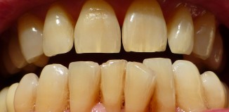 Dental Craze Lines - Hairline Cracks in Your Teeth