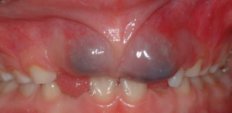 Dental Eruption Cyst Upper Front Teeth