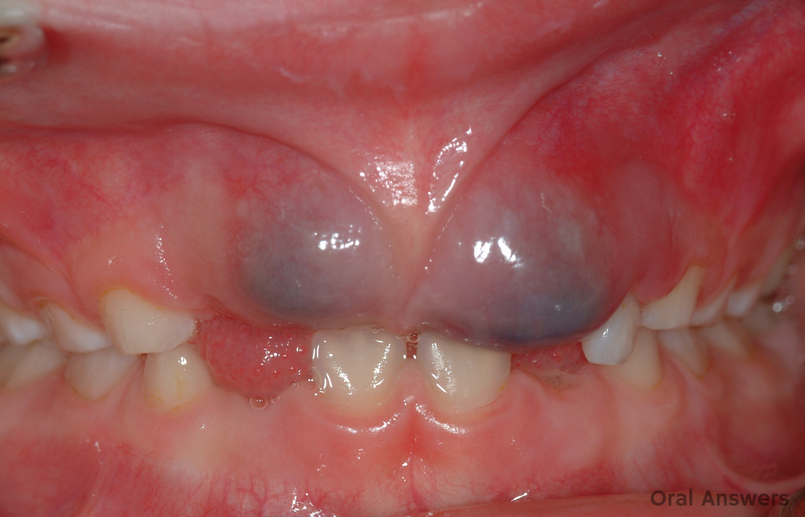 Gum poking through of tooth Bone fragments