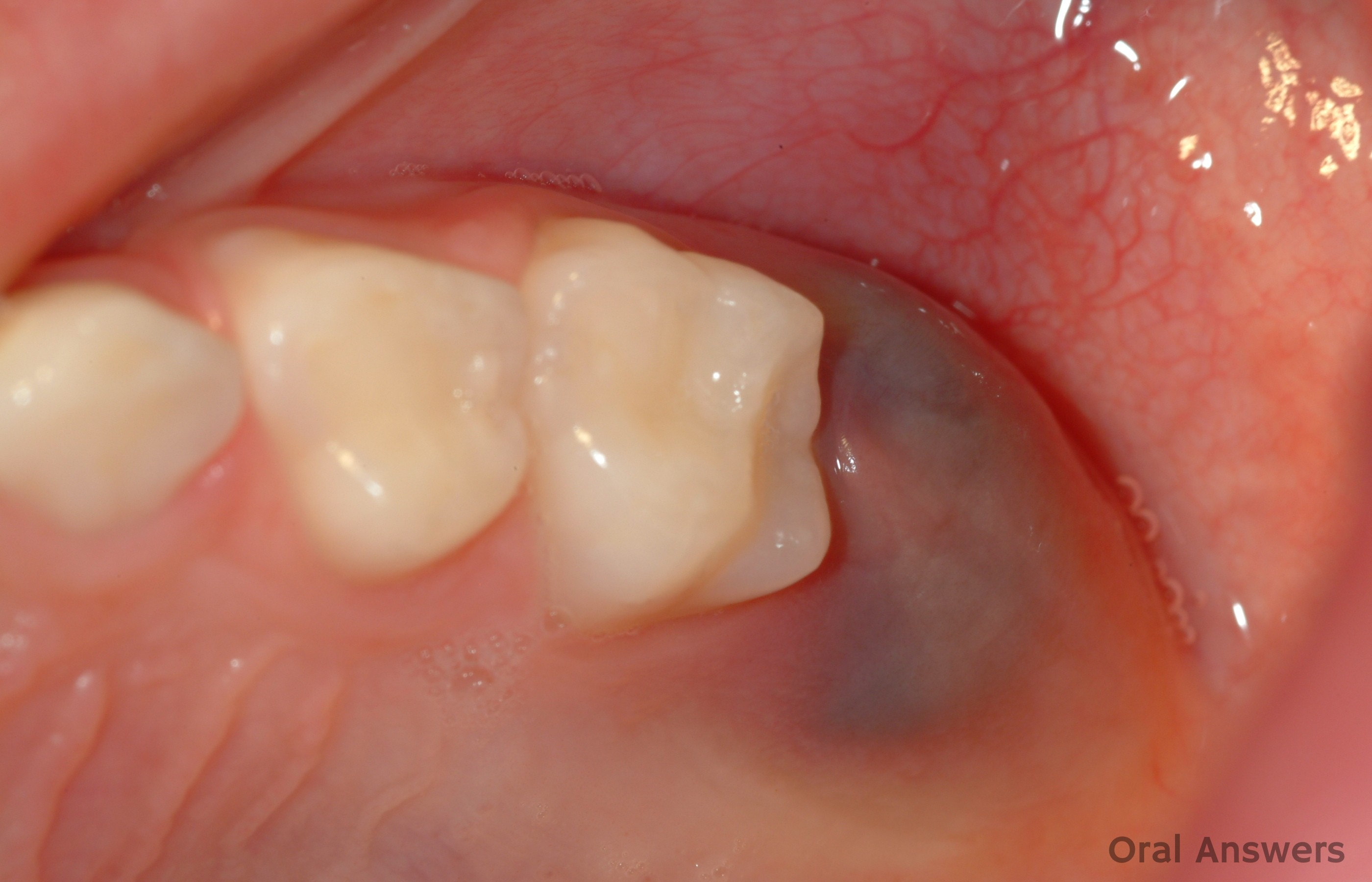 What can cause dark gums around someone's teeth?