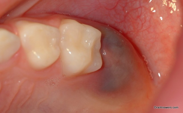 Bump On Gums In Mouth 96