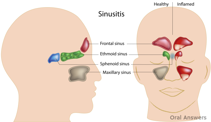 Can sinus infection cause tooth pain   toothache remedies
