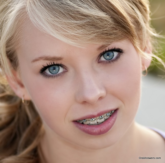 beautiful_teenage_girl_braces.