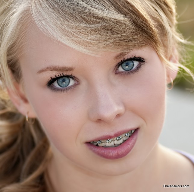 60 Photos Of Teenagers With Braces Oral Answers