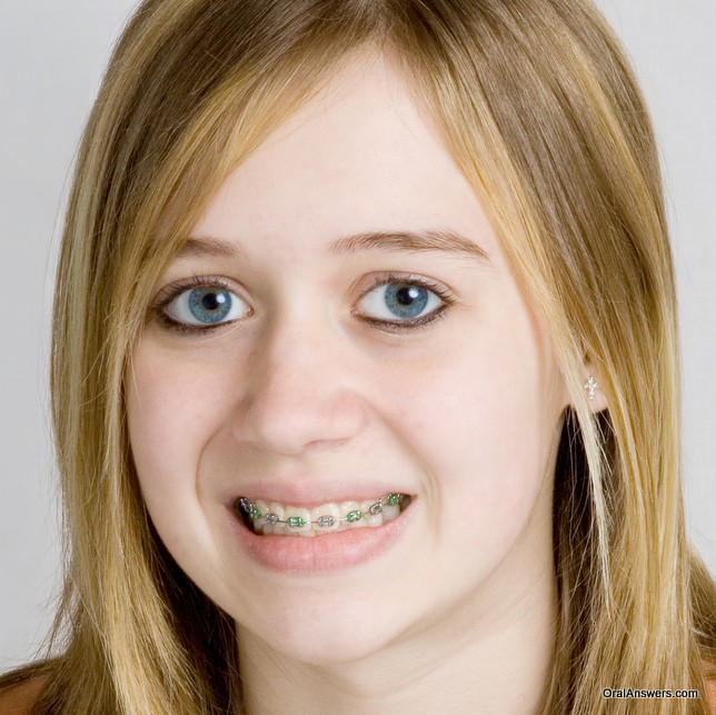 60 Photos of Teenagers with Braces - Robweigner's blog