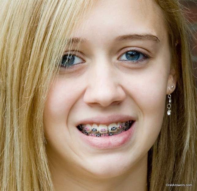 braces_blond_teenager_black_pink_bands