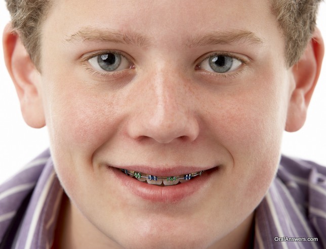 60 Photos of Teenagers with Braces Robweigner's blog