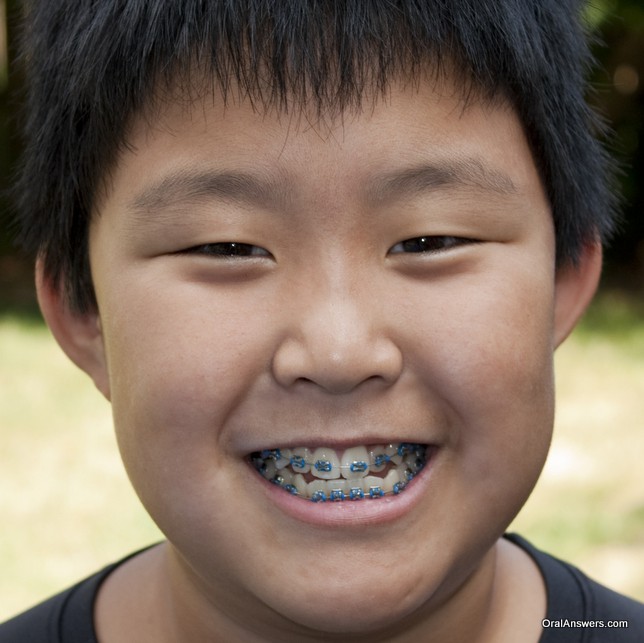 60 Photos of Teenagers with Braces - Robweigner's blog