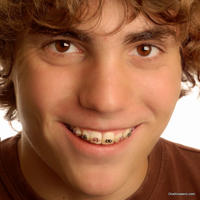 braces_teenage_boy_black_pink_bands