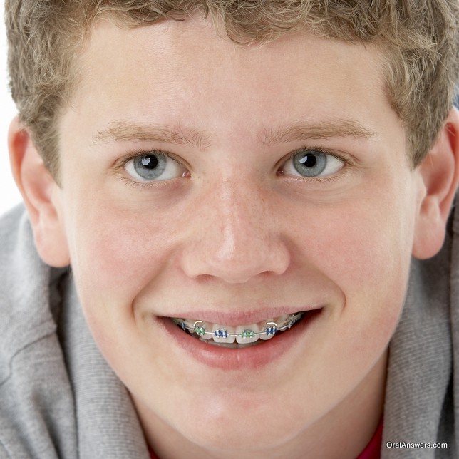 braces_teenage_boy_green_blue_colored_bands