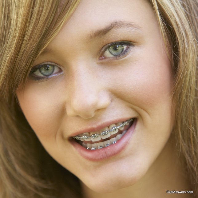 braces_teenage_girl_silver_powerchain