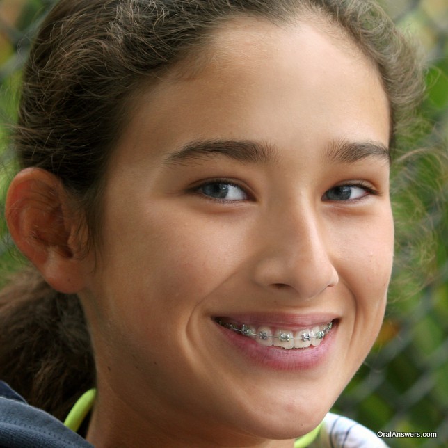braces_teenager_smiling