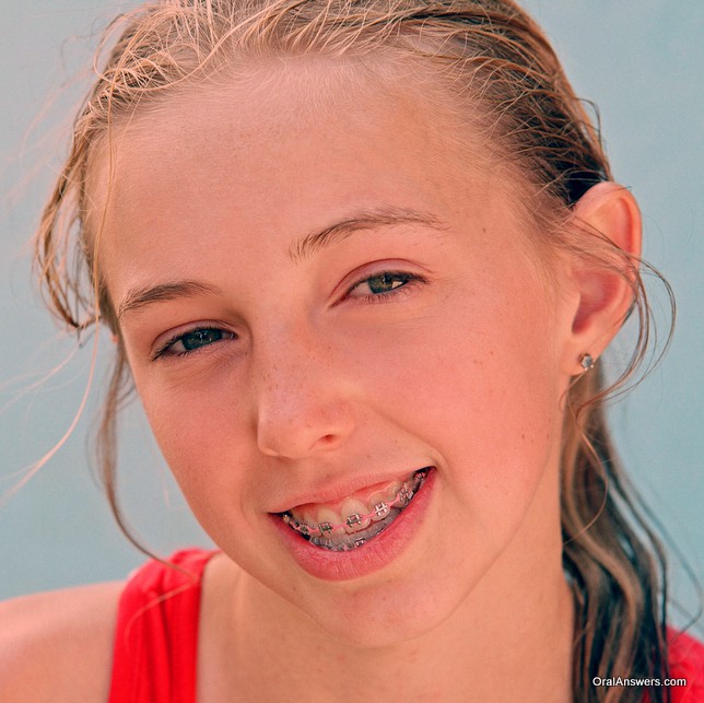 braces_teenager_swimsuit_pink_bands