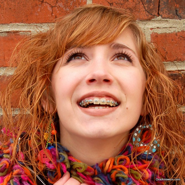 braces_teenager_white_colored_bands