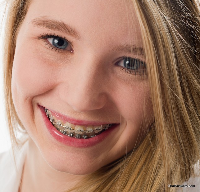 clear_braces_teenage_girl.