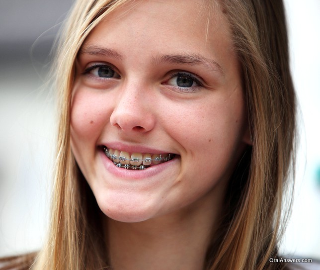 teeange_girl_braces_gray_bands