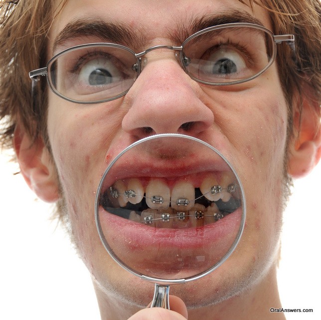 60 Photos of Teenagers with Braces Robweigner's blog