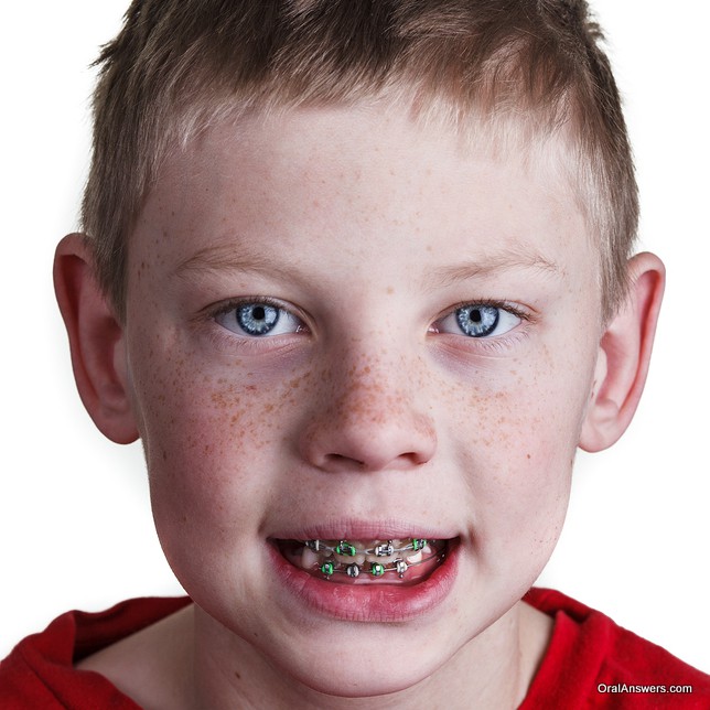 teenage_boy_braces_green_silver_bands