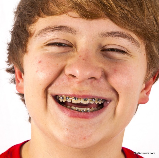 teenage_boy_braces_red_shirt_smiling