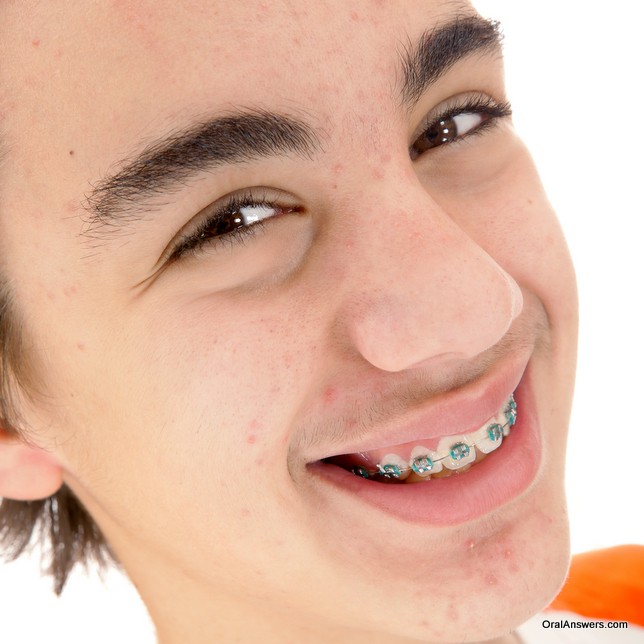 teenage_boy_green_colored_bands