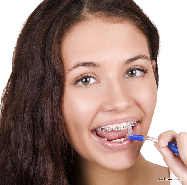 teenage_girl_braces_hygiene