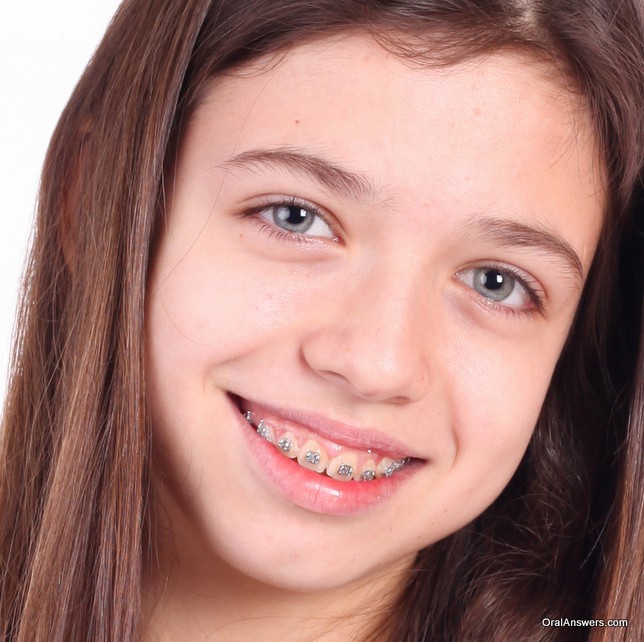 60 Photos Of Teenagers With Braces Oral Answers