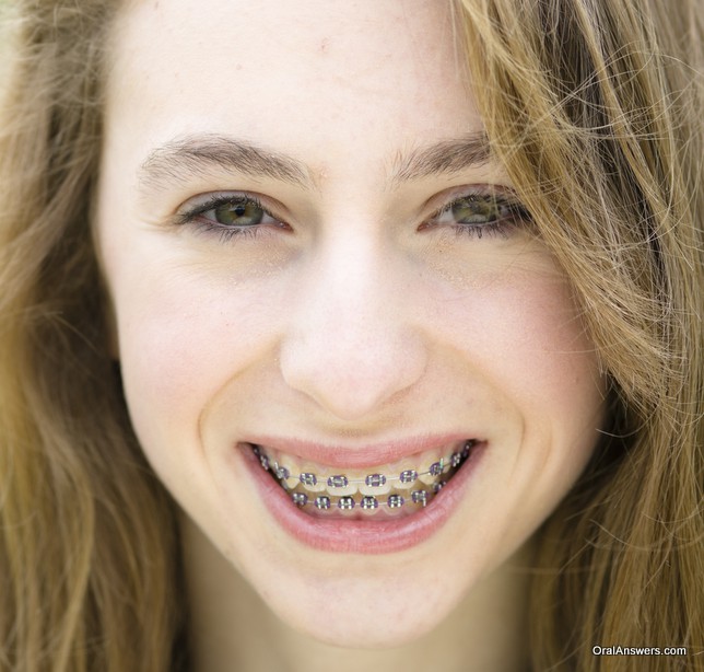 teenage_girl_braces_purple_colored_bands