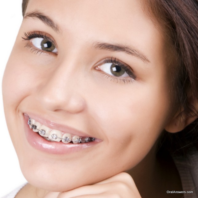 teenage_girl_braces_silver