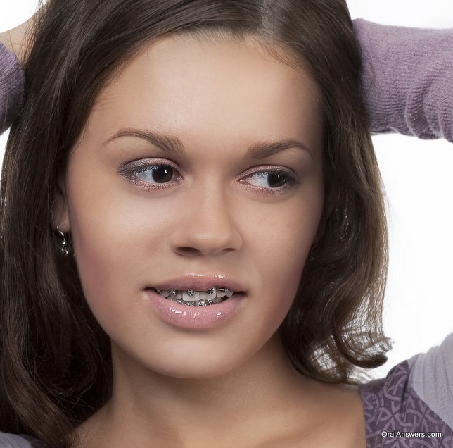 teenage_girl_damon_braces