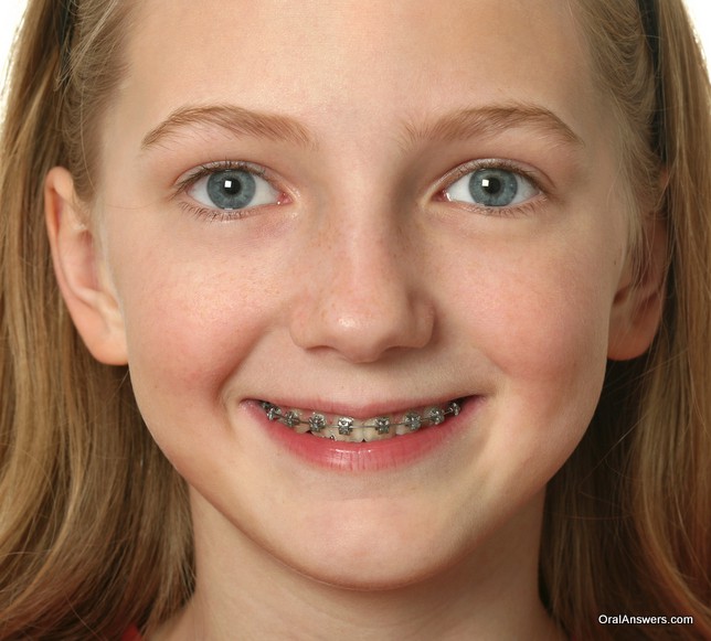 60 Photos Of Teenagers With Braces Robweigners Blog