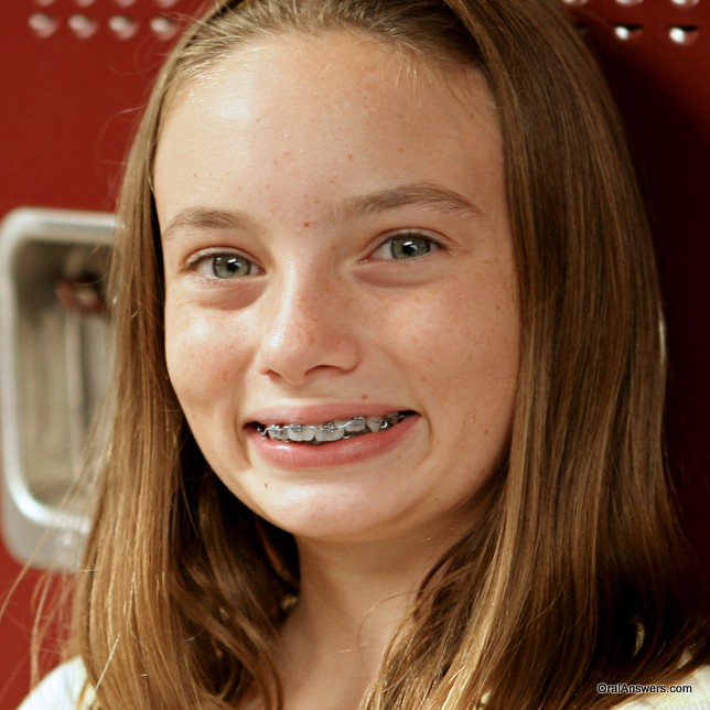 60 Photos Of Teenagers With Braces Robweigners Blog