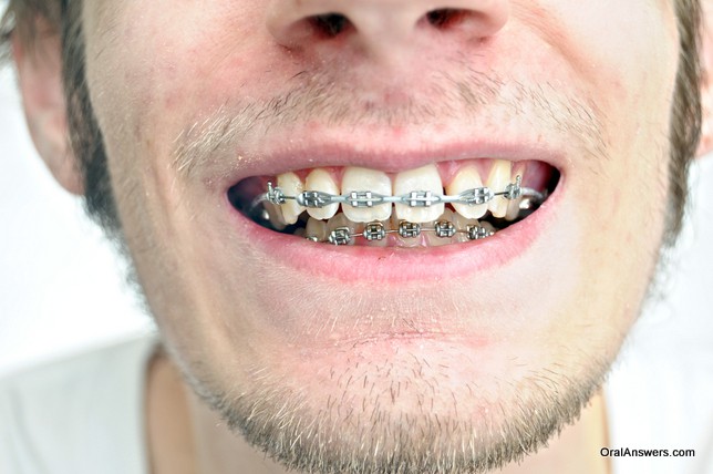 teenager_braces_gray_bands
