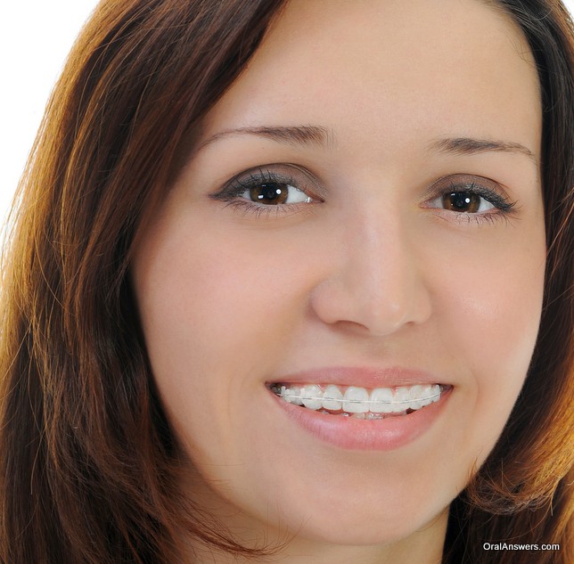 teenager_clear_ceramic_braces