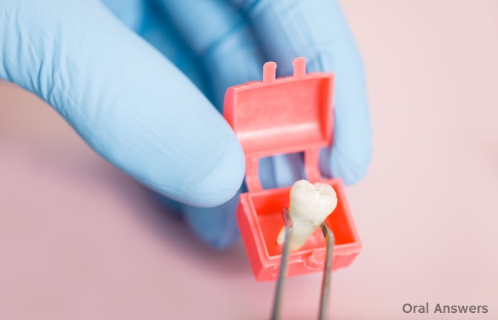 How to Keep Your Extracted Tooth