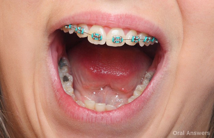 How Long Silver Amalgam Mercury Fillings Last
