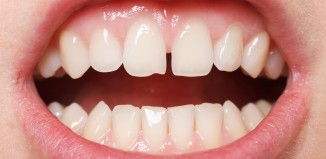 Frenectomy in Children Necessary?