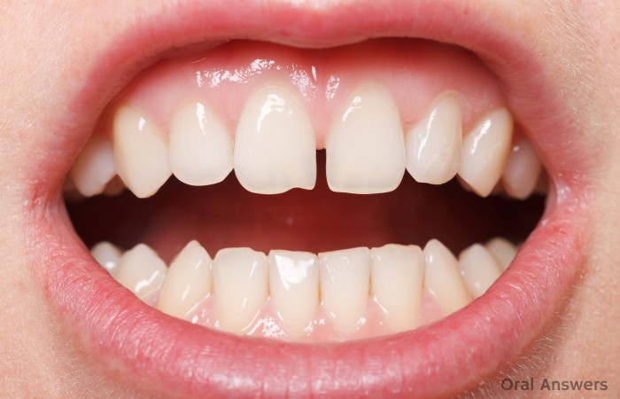 Frenectomy in Children Necessary?