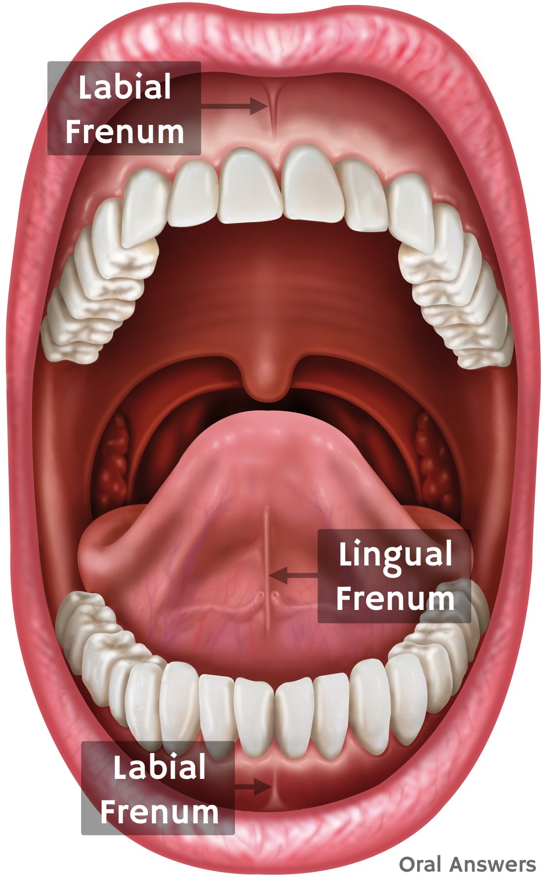 What a Frenectomy is and Why Your Child Might Need One | Oral Answers
