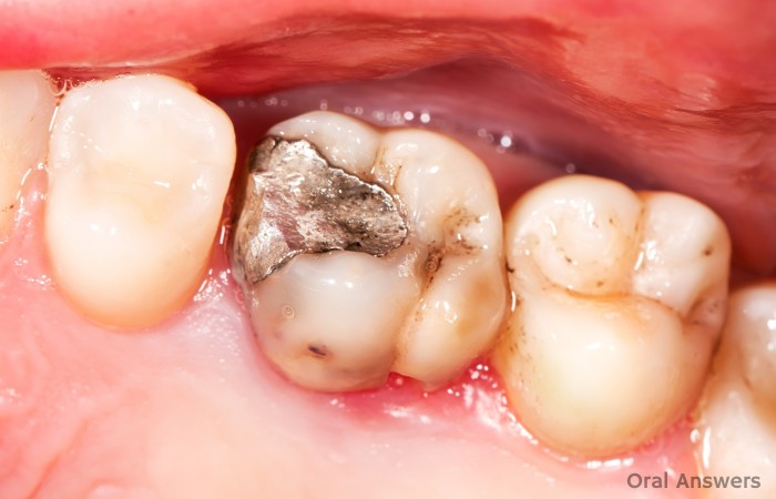 Silver Fillings Mercury Allergies