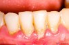 Swollen Gums