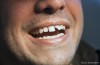 Chipped Tooth Fixed Filling