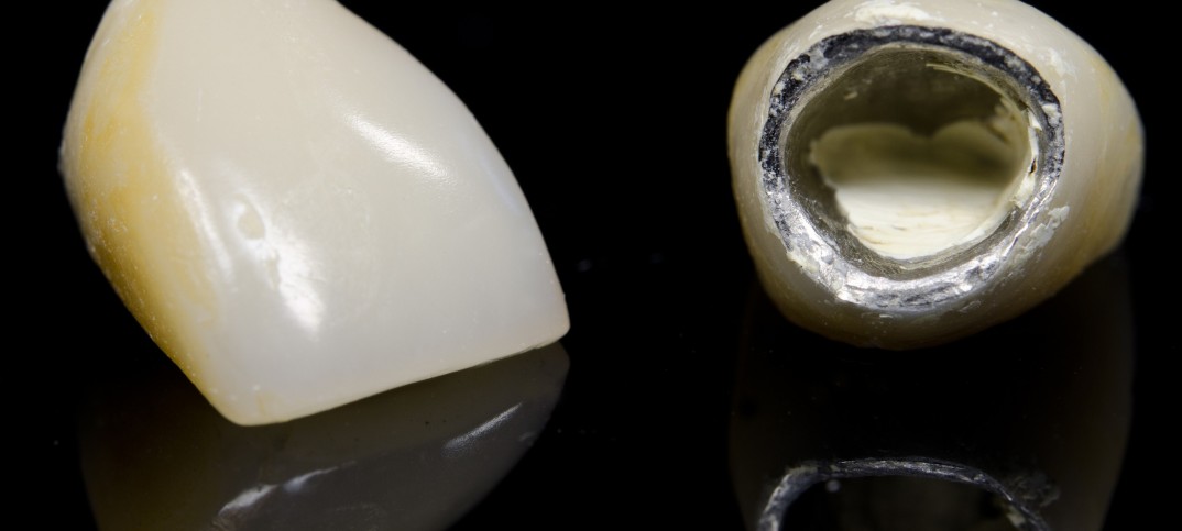 Crown Fell off Tooth