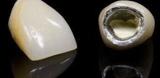 Crown Fell off Tooth