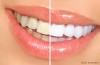 Teeth Whitening Defective Gel