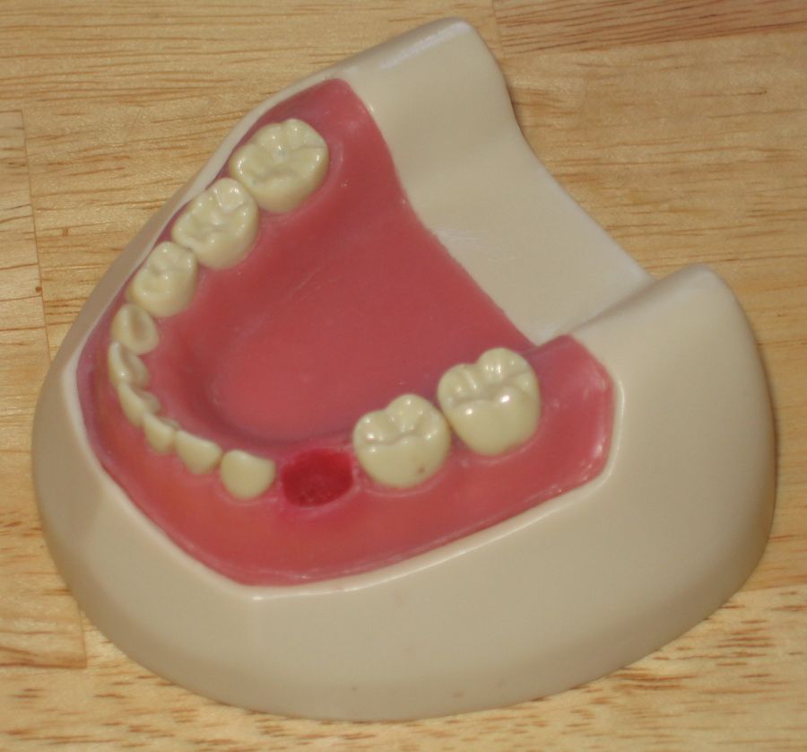How A Space Maintainer Will Look In Your Child’s Mouth ...