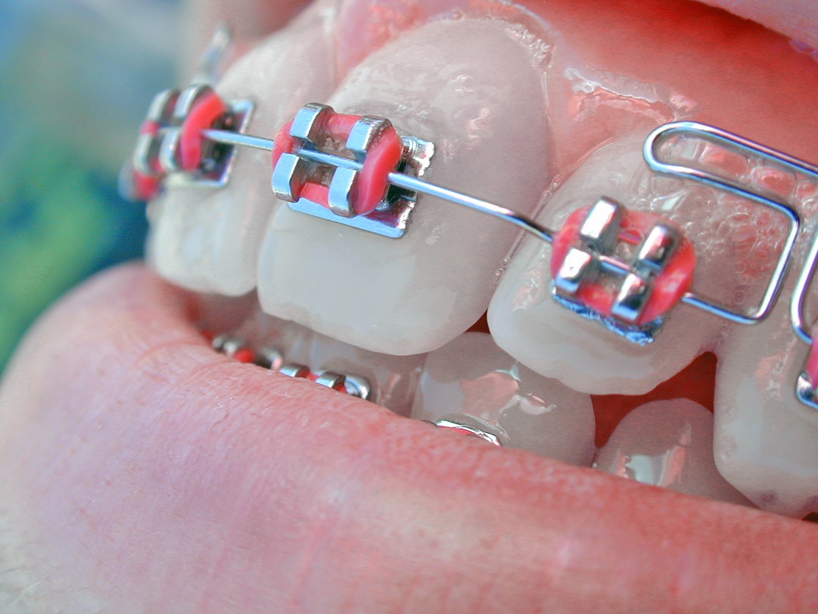 Why You Have to Have Rubber Bands On Each Tooth With Braces Oral Answers