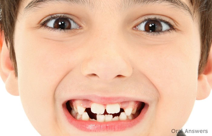 Bumps front Teeth Mamelons
