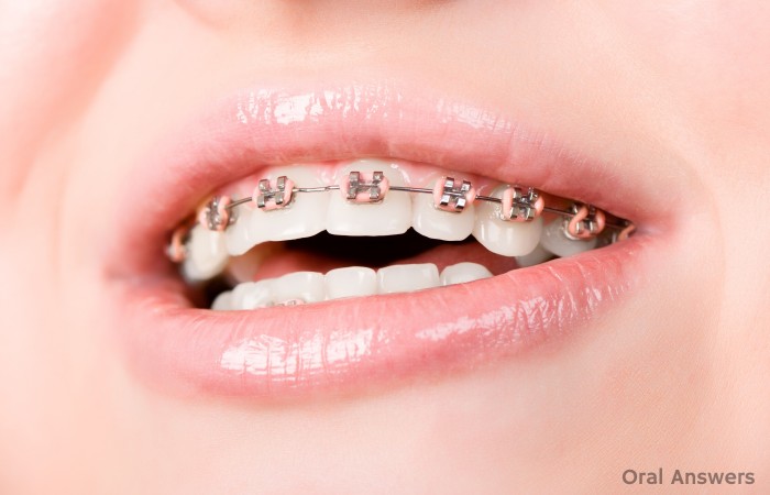 Rubber Bands Brackets Braces